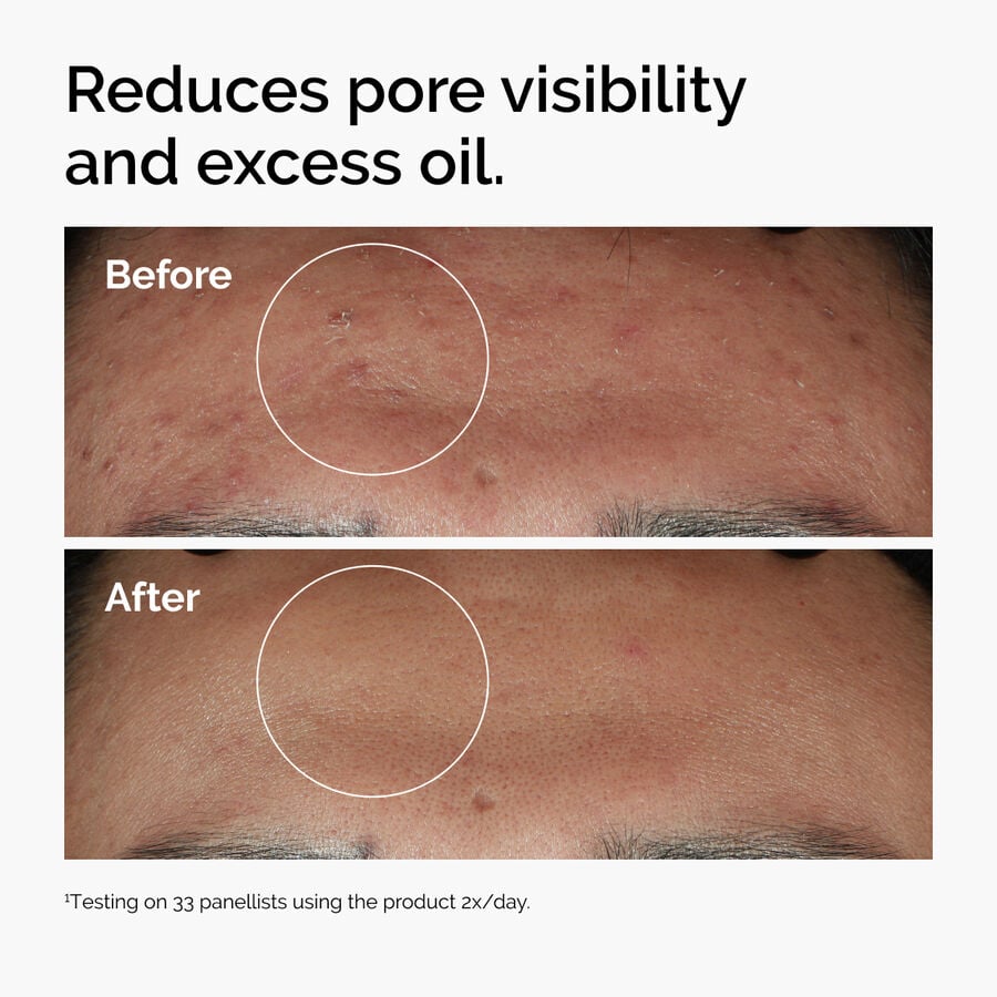 niacinamide-10-zinc-1-n1 ord-niacinamide-zinc-blemish-serum-before-after-pores.jpg
