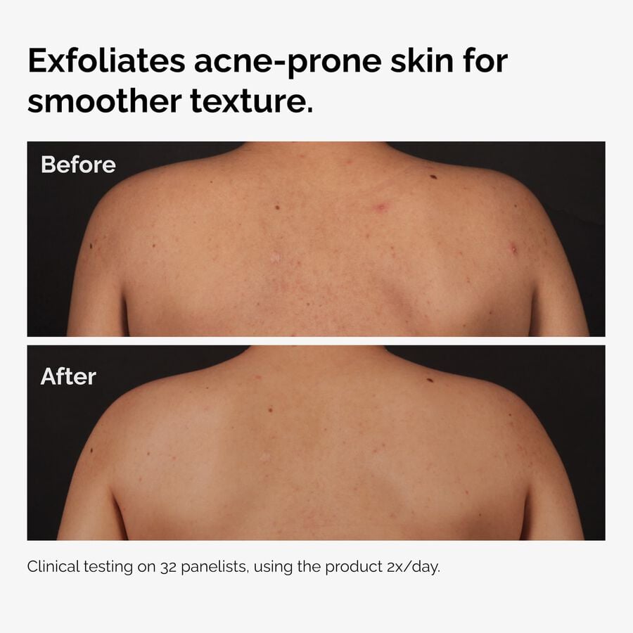 salicylic-acid-0-5-body-serum-r5 ord-salicylic-acid-body-serum-before-after-graphic-NA.jpg