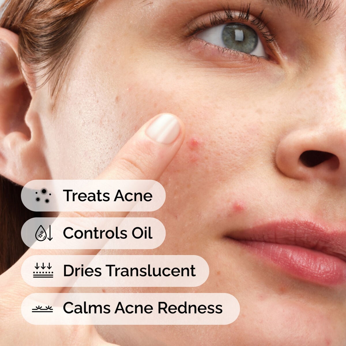 sulfur-10-powder-to-cream-concentrate-p0 ord-sulfur-10pct-powder-to-cream-concentrate-model-application-with-benefits-acne.jpg